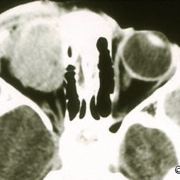 Rhabdomyosarcoma