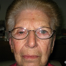 Slight Ptosis (droopy eye lid)