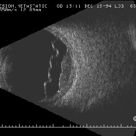 Choroidal metastasis 10 MHz B-scan