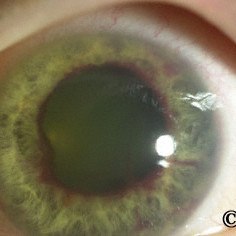 Iris neovascularization