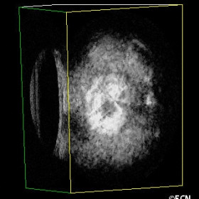 3D ultrasound demonstrates the back of the plaque