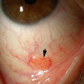 Accessory Lacrimal Gland