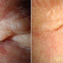 Basal Cell Carcinoma