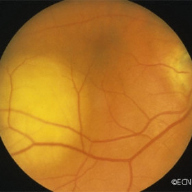 Breast cancer metastasis