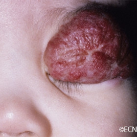Capillary hemangioma of childhood