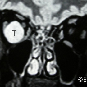 Choroidal Melanoma