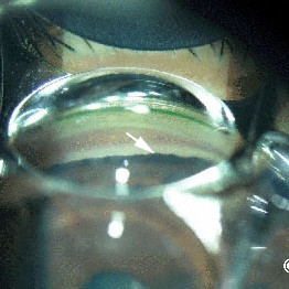 Gonioscopic appearance