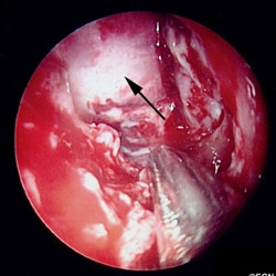 Case # 18 Intraoperative transnasal video photography
