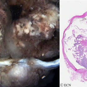 Retinoblastoma