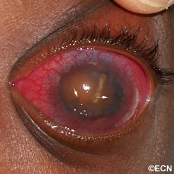 The left eye is enlarged.