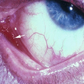 Kaposis sarcoma of the conjunctiva