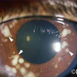 Retinoblastoma seeds on the iris