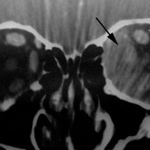 Sclerosing pseudotumor
