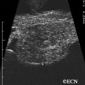 Ciliary body melanoma