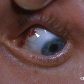 Lymphangioma of the conjunctiva