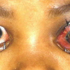 Retinoblastoma with orbital extension