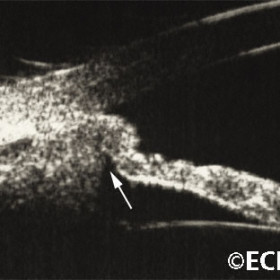 Ciliary body melanoma