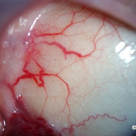 Lymphangioma of the conjunctiva