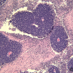 Retinoblastoma