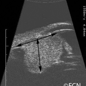 Ciliary Body Melanoma
