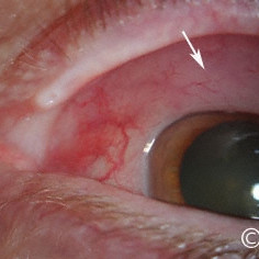 Lymphoma of the conjunctiva