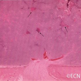 Retinoblastoma with intratumoral calcifications (arrows).