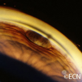 Iris stromal cyst