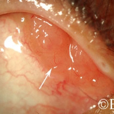 Lymphoma of the conjunctiva
