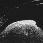 Ciliary body melanomas