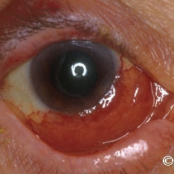 Lymphoma of the conjunctiva