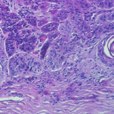 Squamous carcinoma of the conjunctiva