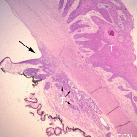 Squamous carcinoma of the conjunctiva
