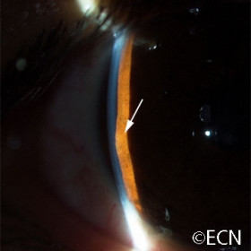 Neuro-epithelial iris cyst