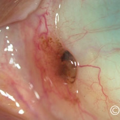 Nevus of the conjunctiva at the plica