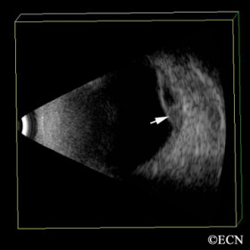 Hemorrhagic choroidal detachment