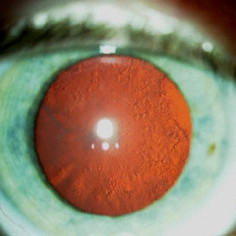 Radiation associated posterior subcapsular (PSC) cataract