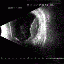 A 2-dimensional 10 MHz transocular ultrasound