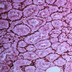 Capillary hemangioma specimen from a child.