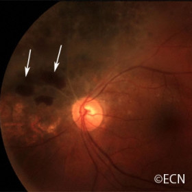 Choroidal Melanoma
