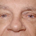 Enucleation with implant I