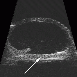 Case 1: High Frequency Ultrasound