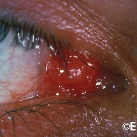 Pedunculated conjunctival papilloma