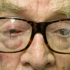 Radiation blocking glasses