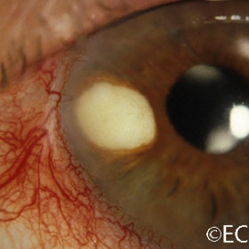 Pearl cyst of the iris