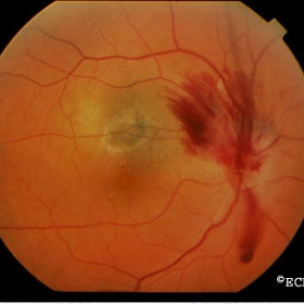 Radiation optic neuropathy
