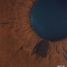 Small iris melanocytoma