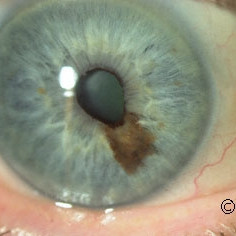 Suspicious Iris Nevus