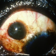 Post-hemorrhagic chocolate conjunctival cyst