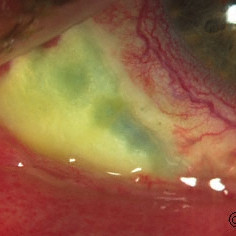 Scleral necrosis seen after ruthenium