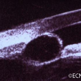 Iris stromal cyst (50-MHz ultrasound)